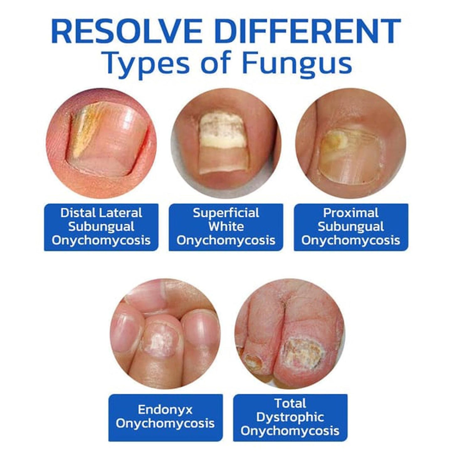 (Y)Nail Fungus Laser Device, Anti Fungal Treatment Laser-Device For Onychomycosis