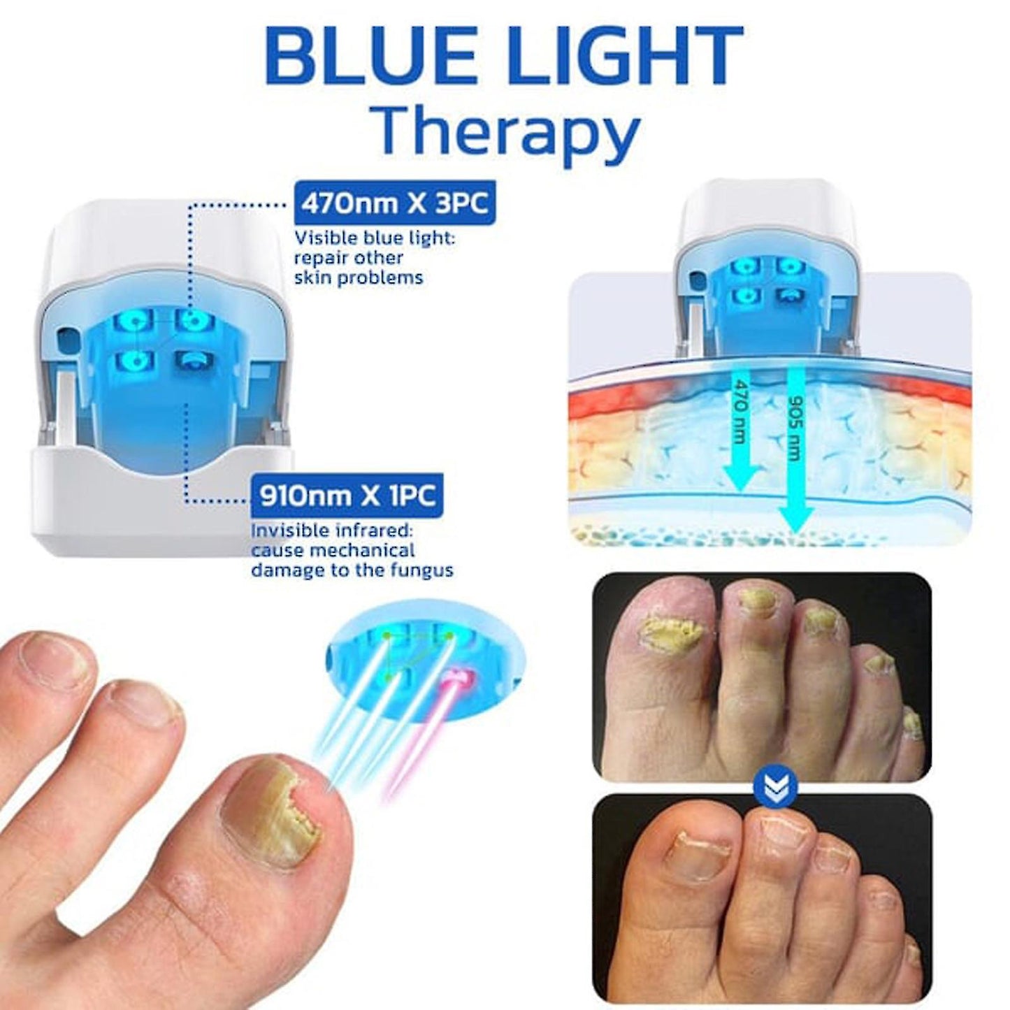 (Y)Nail Fungus Laser Device, Anti Fungal Treatment Laser-Device For Onychomycosis