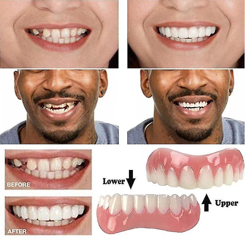 (Y)Extra Thin Fake Bright White Tooth Veneers Silicone Soft Safe Adhesive Denture Hide Shade Braces Comfortable Teeth Orthodontic